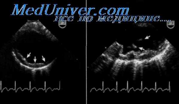 атеросклероз аорты