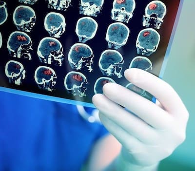 МРТ диагностика аневризмы головного мозга