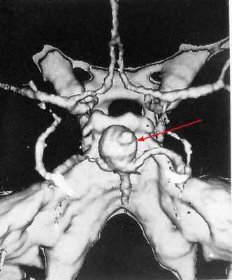 anevrisma_2 meshot.jpg