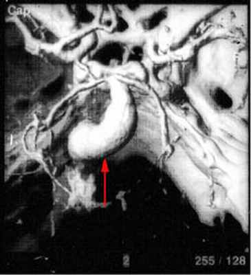 anevrisma_3 fuziform.jpg