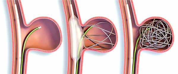 Эмболизация аневризмы сосудов головного мозга