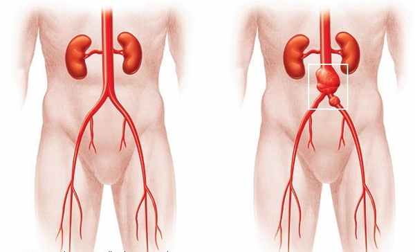 аневризма печеночной артерии