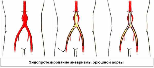 эндопротезирование аневризмы брюшной аорты