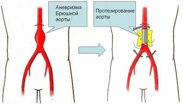 протезирование аневризмы брюшной аорты
