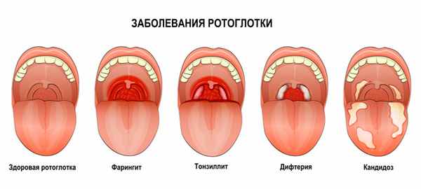 Причины ангины.jpg