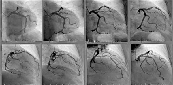 Ангиография сосудов
