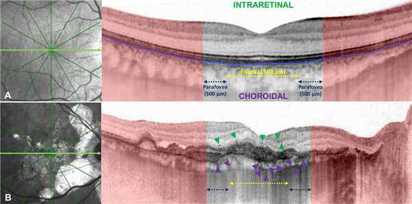 Ангиоидные полосы сетчатки - что это и как лечить