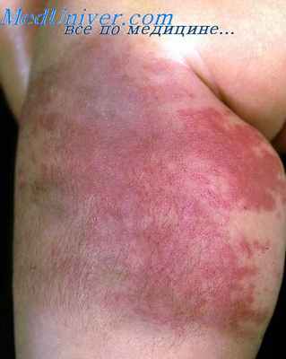 ангиома старческая