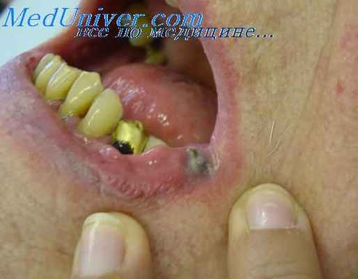 пиогенные гранулемы