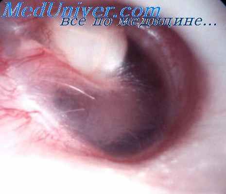 меланома наружного слухового прохода