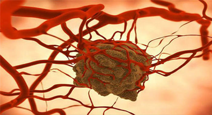 Ангиосаркома