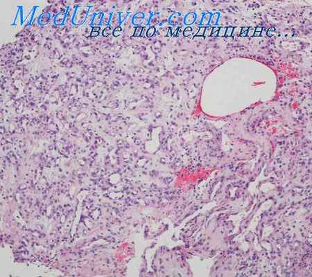 ангиосаркома