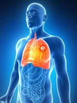 Рак легкого