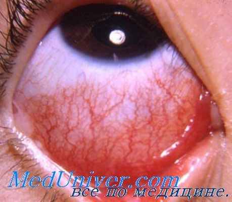 ангиостронгилез глаз