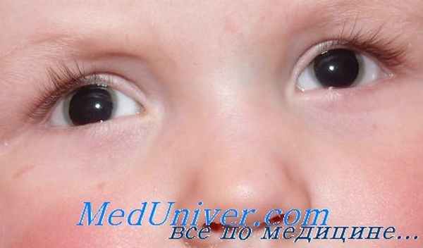 аниридиа у ребенка