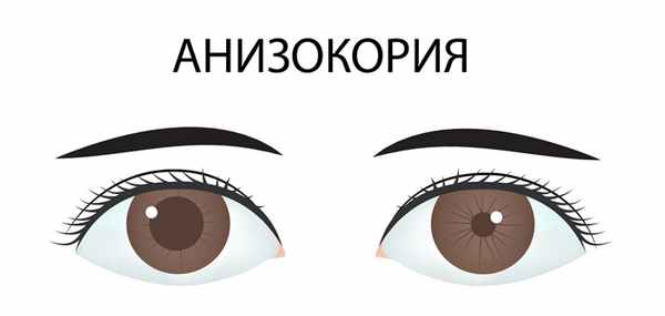 Анизокория