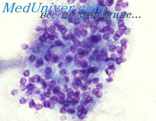 стронгилоидоз