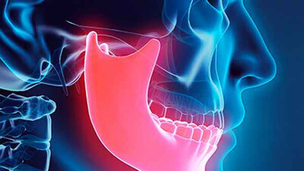 анкилоз ВНЧС