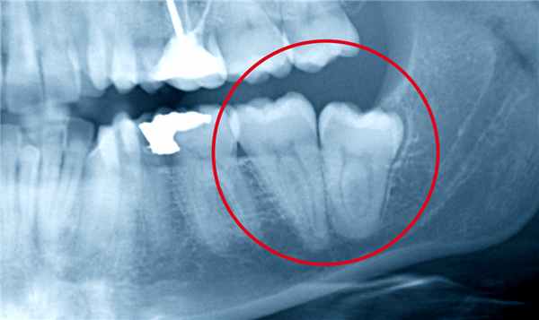 Анкилоз ВНЧС