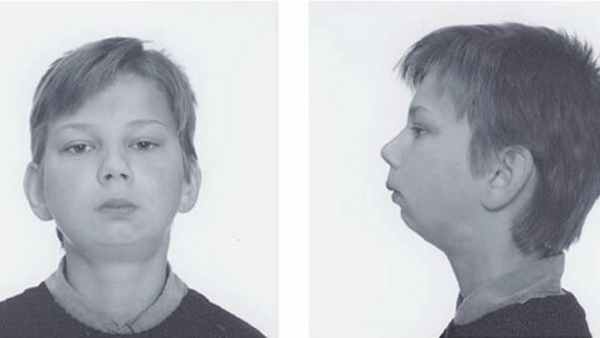 анкилоз внчс