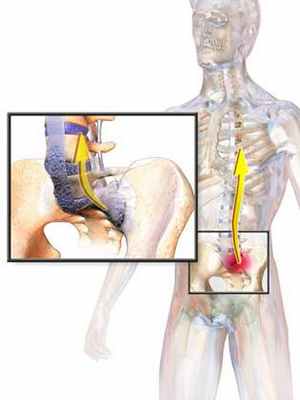 Анкилозирующий спондилит (болезнь Бехтерева)