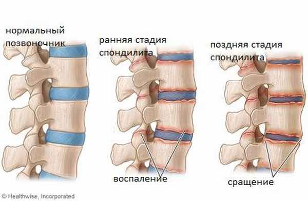 Анкилозирующий спондилит (болезнь Бехтерева)