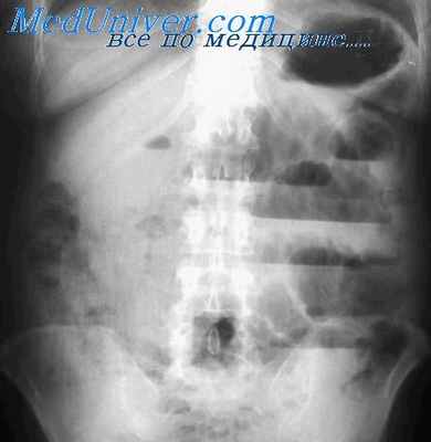 дискинезии тощей кишки