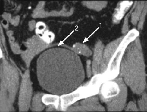 Аномалии яичек