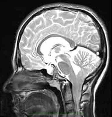 arnold chiari - tension_filum_terminale_02