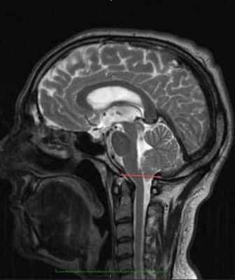arnold chiari - evolucion_seccion_filum_terminale_2008_caso-16453