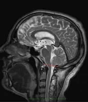 arnold chiari - 2010