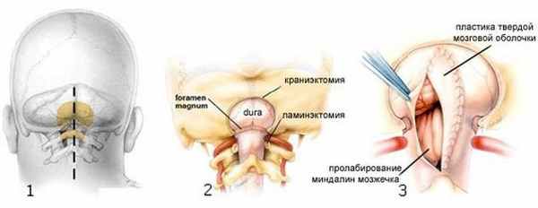 Схематическое изображение классической субокципитальной краниэктомии при ААК. 