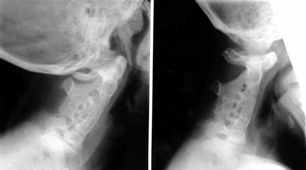 Слияние позвонков