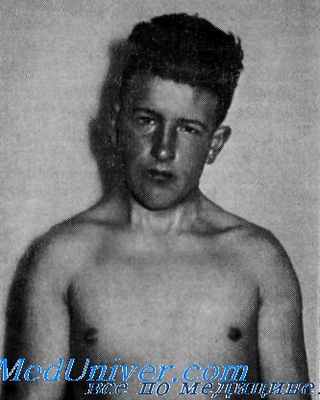 аномалия клиппеля-фейля