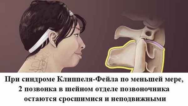 сращение шейных позвонков