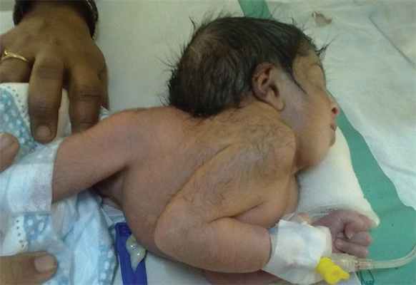 аномалия Клиппеля Фейля