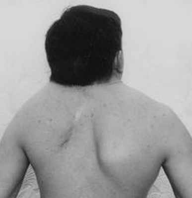 Аномалия лопаток