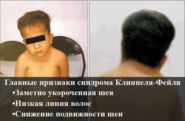 Синдром Клиппеля-Фейла (KFS) 