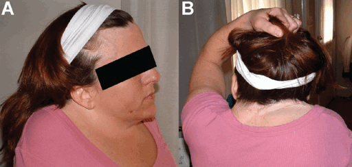 аутосомно доминантное проявление