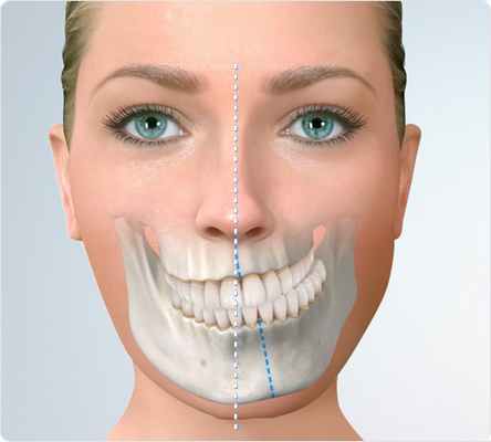 Перекрестный прикус