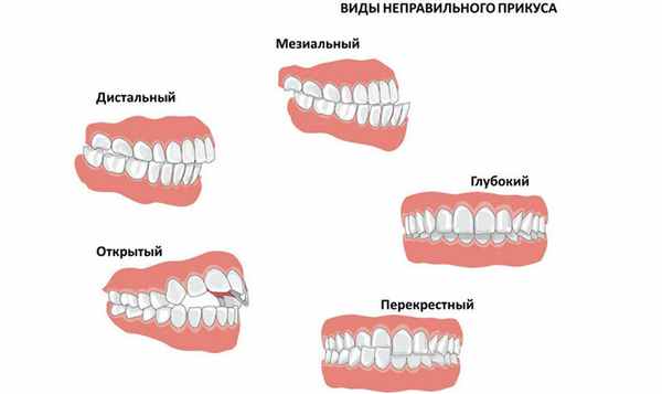 Аномалии прикуса
