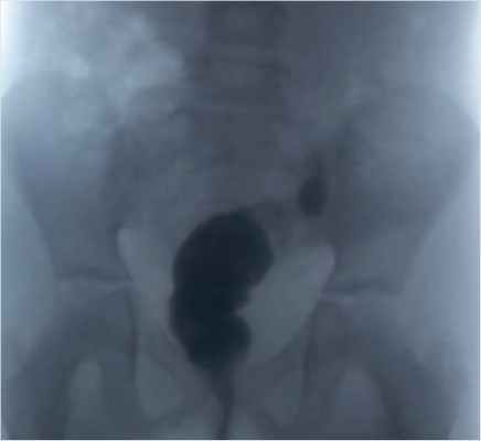 Ирригография при катамнестическом обследовании через 6 мес. после операции