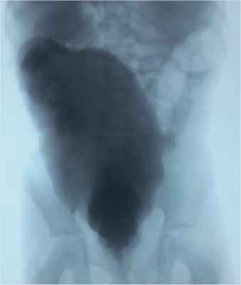 Ирригография перед повторной аноректопластикой