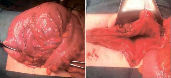 Интраоперационная картина: выраженно расширенный ректосигмоидный отдел