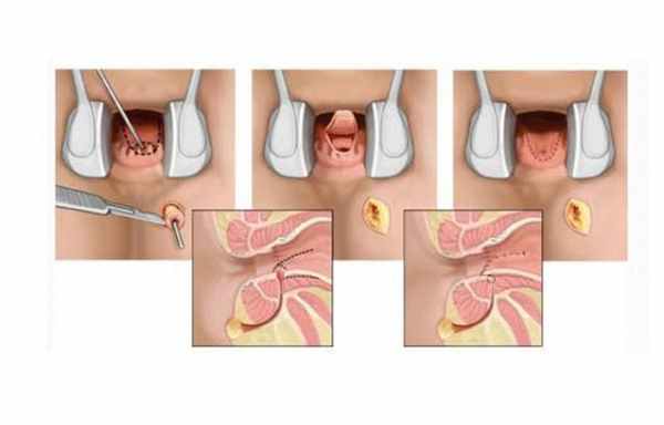 Свищ прямой кишки как выглядит и лечение