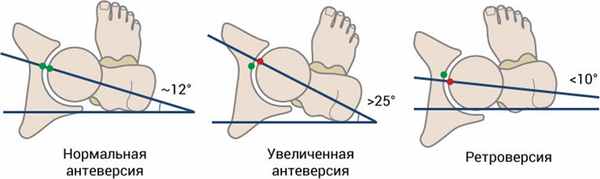 Шейка бедра, рисунок