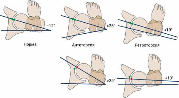 Шейка бедра, схема