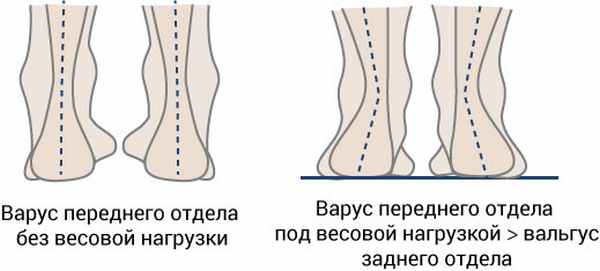 Варус стопы, рисунок