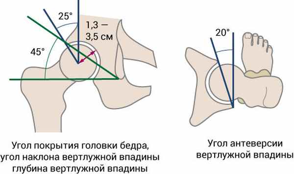 Угол наклона вертлужной впадины, рисунок