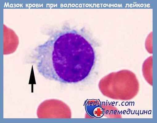 Мазок крови при волосатоклеточном лейкозе